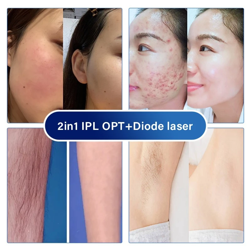 Hospital Use Laser Hair Removal Machine – Professional-Grade Hair Removal And Skin Rejuvenation