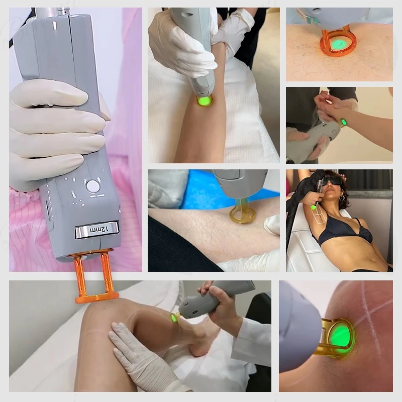 alexandrite laser hair removal